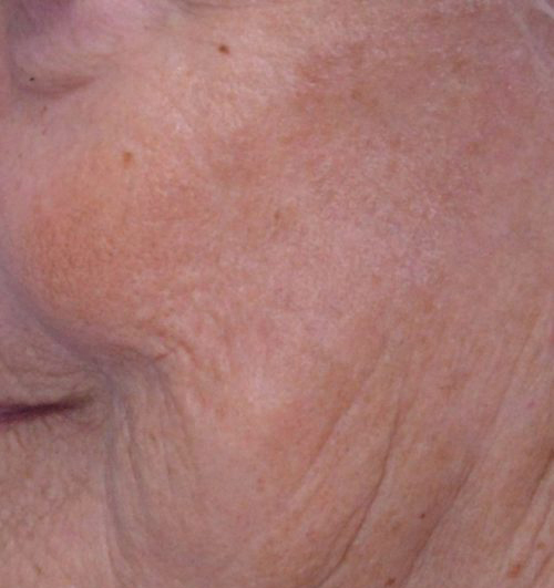 Laser Resurfacing Treament with Fractional CO2 Laser Results Reno