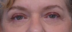 Blepharoplasty