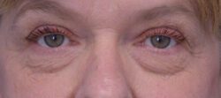 Blepharoplasty