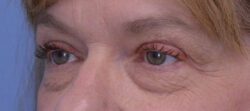 Blepharoplasty