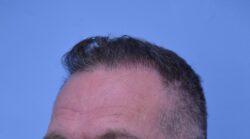 Hair Transplant