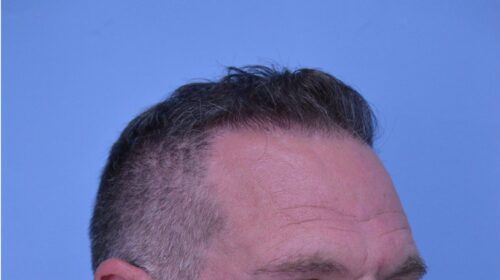 Hair Transplant