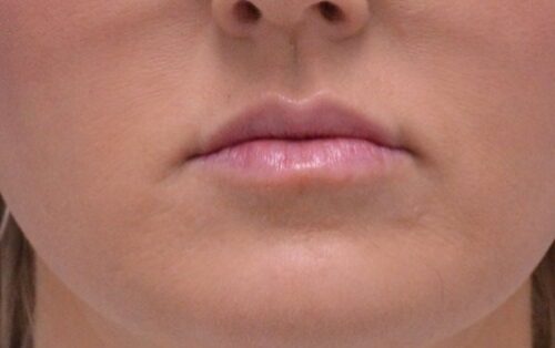 Lip Fillers in Reno Results After