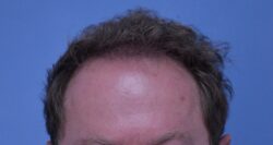 Hair Transplant