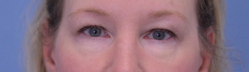 Blepharoplasty