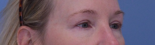 Blepharoplasty