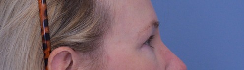 Blepharoplasty