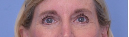 Blepharoplasty