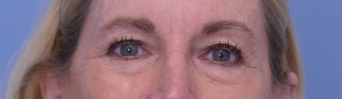 Blepharoplasty