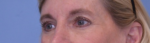 Blepharoplasty