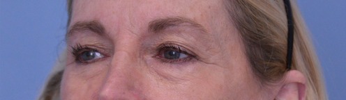 Blepharoplasty