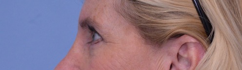 Blepharoplasty