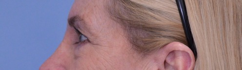 Blepharoplasty