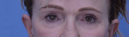 Blepharoplasty