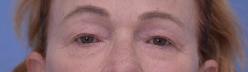 Blepharoplasty