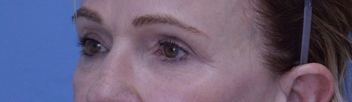 Blepharoplasty