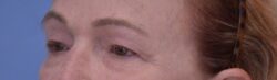 Blepharoplasty