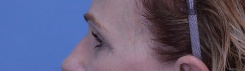 Blepharoplasty