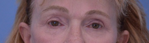 Blepharoplasty