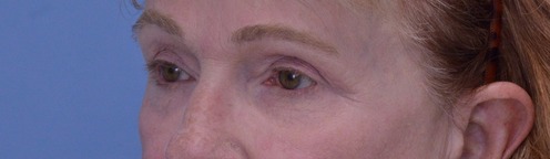 Blepharoplasty