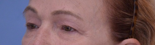 Blepharoplasty