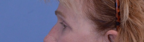 Blepharoplasty