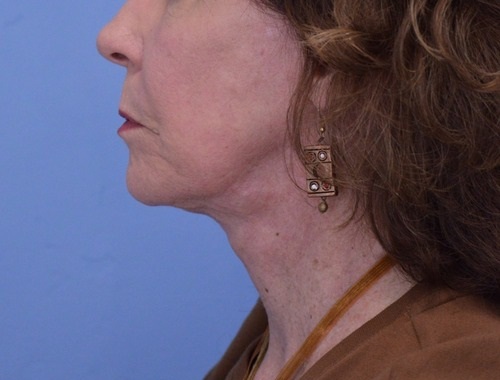 Face and Neck Lift