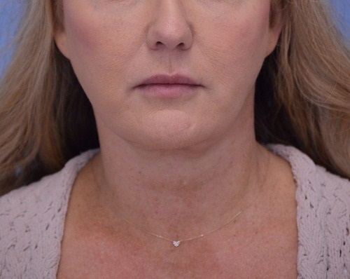 Face and Neck Lift