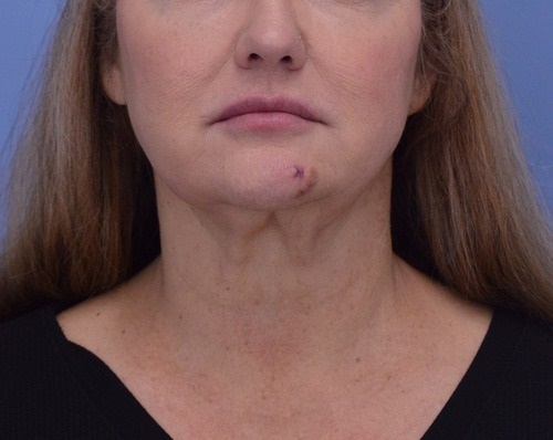 Face and Neck Lift