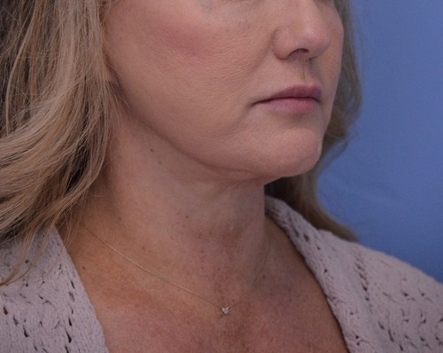 Face and Neck Lift