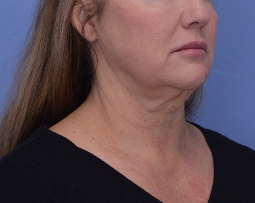 Face and Neck Lift