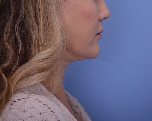 Face and Neck Lift