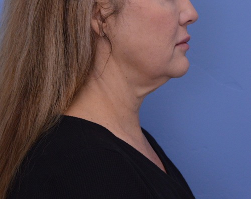 Face and Neck Lift