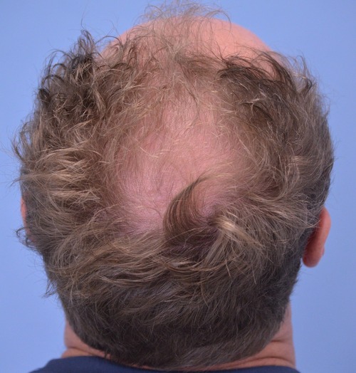 Hair Transplant