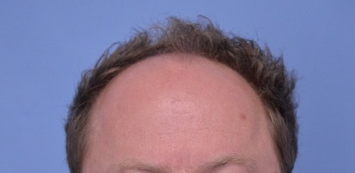 Hair Transplant