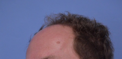 Hair Transplant