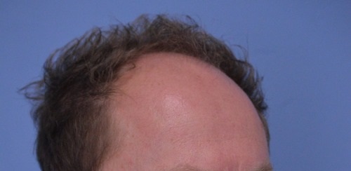 Hair Transplant