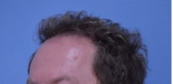 Hair Transplant