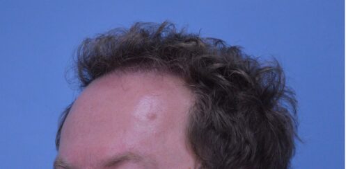 Hair Transplant