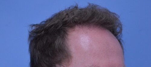 Hair Transplant