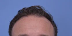 Hair Transplant