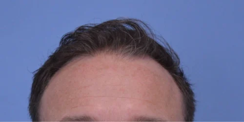 Hair Transplant