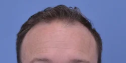 Hair Transplant