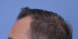 Hair Transplant