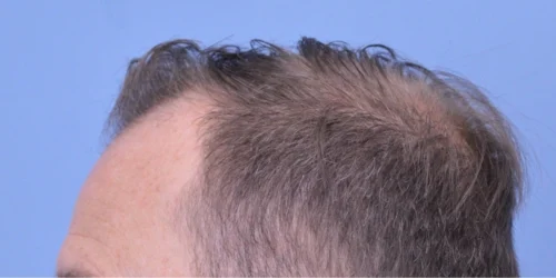 Hair Transplant