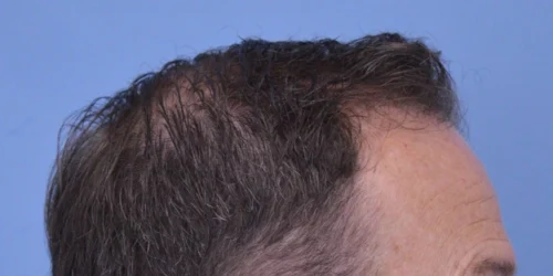 Hair Transplant