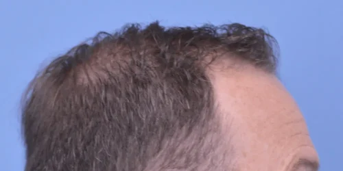 Hair Transplant