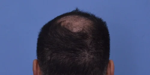 Hair Transplant