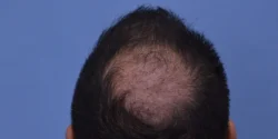 Hair Transplant