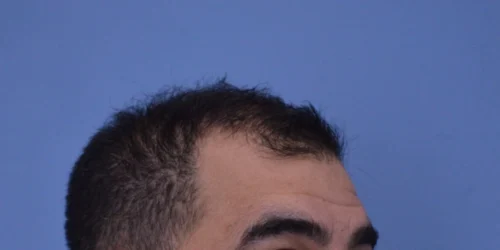 Hair Transplant